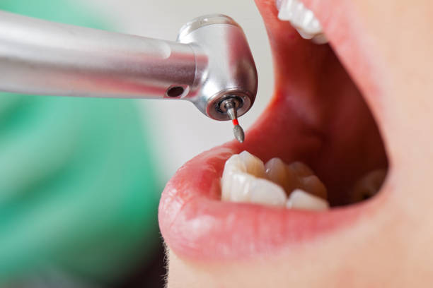 Best Broken or Cracked Tooth Emergency Dentist in Spring House, PA